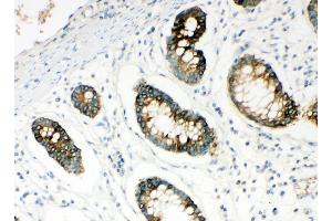 Anti-HYAL1 antibody,  IHC(P) IHC(P): Human Intestinal Cancer Tissue