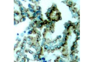 Immunohistochemistry of paraffin-embedded human lung carcinoma tissue, using Phospho-PKCalpha/beta II-T638/641 antibody (ABIN3019760, ABIN3019761, ABIN3019762, ABIN1681948 and ABIN1681949). (PRKCA/PRKCB (pThr638), (pThr641) antibody)