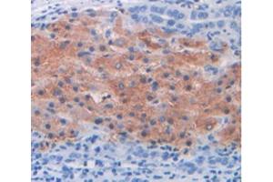 IHC-P analysis of Human Liver Cancer Tissue, with DAB staining. (MUC2 antibody  (AA 5075-5179))