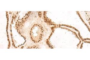Immunohistochemistry of paraffin-embedded Human thyroid cancer tissue using MKX Polyclonal Antibody at dilution of 1:60(x200) (MKX antibody)