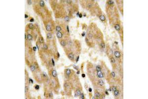 Immunohistochemical analysis of Fibronectin staining in human liver cancer formalin fixed paraffin embedded tissue section.