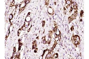 Paraformaldehyde-fixed, paraffin embedded human gastric cancer, Antigen retrieval by boiling in sodium citrate buffer (pH6) for 15min, Block endogenous peroxidase by 3% hydrogen peroxide for 30 minutes,  Blocking buffer (normal goat serum) at 37°C for 20min, Antibody incubation with ADAM17 (Thr735) Polyclonal Antibody (bs-12477R) at 1:400 overnight at 4°C, followed by a conjugated secondary and DAB staining. (ADAM17 antibody  (pThr735))