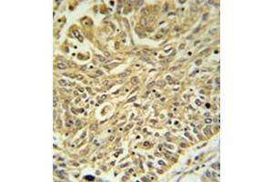 Immunohistochemistry analysis in formalin fixed and paraffin embedded lung carcinoma reacted with GSTK1 Antibody (Center) followed by peroxidase conjugation of the secondary antibody and DAB staining. (GSTK1 antibody  (Middle Region))