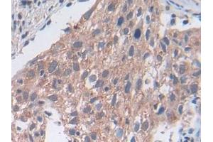 Detection of UTRN in Human Lung cancer Tissue using Polyclonal Antibody to Utrophin (UTRN) (Utrophin antibody  (AA 1-252))