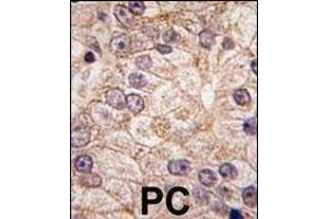 Formalin-fixed and paraffin-embedded human prostata carcinoma tissue reacted with PI4K II beta antibody (N-term), which was peroxidase-conjugated to the secondary antibody, followed by DAB staining. (PI4K2B antibody  (N-Term))