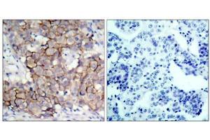 Immunohistochemical analysis of paraffin-embedded human breast carcinoma tissue, using HER2 (phospho- Tyr877) antibody (E011075). (ErbB2/Her2 antibody  (pTyr877))