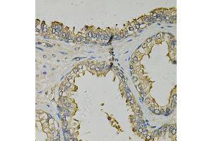 Immunohistochemistry of paraffin-embedded human prostate using FABP1 Antibody (ABIN5973056) at dilution of 1/100 (40x lens). (FABP1 antibody)