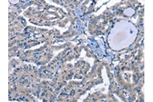 The image on the left is immunohistochemistry of paraffin-embedded Human thyroid cancer tissue using (LRRK2 Antibody) at dilution 1/30, on the right is treated with fusion protein.