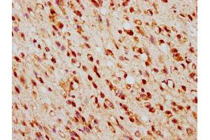 IHC image of ABIN7172910 diluted at 1:500 and staining in paraffin-embedded human glioma performed on a Leica BondTM system. (TSNAX antibody  (AA 1-87))