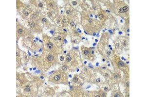 Immunohistochemistry of paraffin-embedded Human liver damage using MAT1A Polyclonal Antibody at dilution of 1:100 (40x lens). (MAT1A antibody)