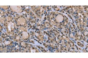 Immunohistochemistry of paraffin-embedded Human thyroid cancer tissue using DYNLL1 Polyclonal Antibody at dilution 1:30 (DYNLL1 antibody)