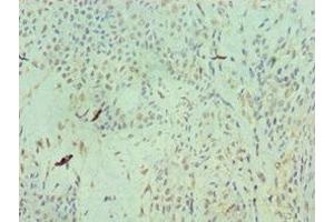 Immunohistochemistry of paraffin-embedded human breast cancer using ABIN7154577 at dilution of 1:100 (RAN antibody  (AA 1-216))