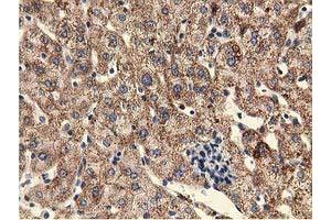 Immunohistochemical staining of paraffin-embedded Carcinoma of Human lung tissue using anti-UHMK1 mouse monoclonal antibody. (UHMK1 antibody)