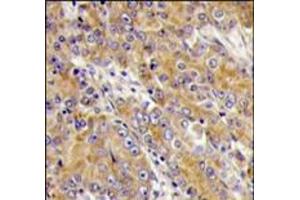 Formalin-fixed and paraffin-embedded human prostata carcinoma tissue reacted with MYO1C antibody (C-term), which was peroxidase-conjugated to the secondary antibody, followed by DAB staining. (Myosin IC antibody  (C-Term))