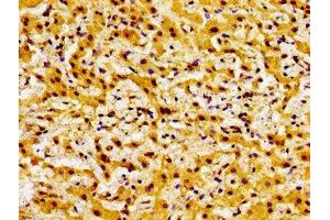 Immunohistochemistry of paraffin-embedded human liver cancer using ABIN7145314 at dilution of 1:100 (BOK antibody  (AA 15-103))