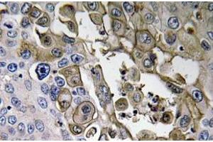 Immunohistochemistry (IHC) analyzes of RAGE antibody in paraffin-embedded human lung carcinoma tissue. (RAGE antibody)