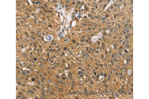 Immunohistochemistry of Human breast cancer using SORT1 Polyclonal Antibody at dilution of 1:35 (Sortilin 1 antibody)
