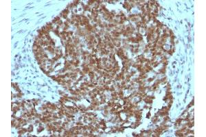 Formalin-fixed, paraffin-embedded human Ovarian carcinoma stained with Nucleolin MAb (364-5 + NCL/902). (Nucleolin antibody)