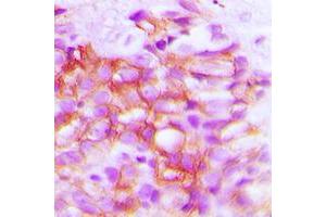 Immunohistochemical analysis of TRP2 staining in human breast cancer formalin fixed paraffin embedded tissue section.