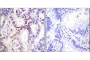 Immunohistochemistry analysis of paraffin-embedded human lung carcinoma tissue, using p15 INK Antibody. (CDKN2B antibody  (AA 89-138))