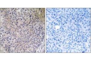 Immunohistochemistry analysis of paraffin-embedded human lung carcinoma tissue, using NDUFS7 Antibody.