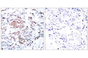 Immunohistochemical analysis of paraffin-embedded human breast carcinoma tissue using STAT5A (Ab-694) antibody (E021048). (STAT5A antibody)