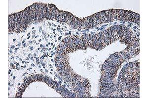 Immunohistochemical staining of paraffin-embedded Adenocarcinoma of Human endometrium tissue using anti-DLD mouse monoclonal antibody. (DLD antibody)