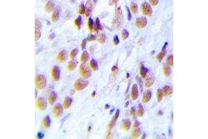 Immunohistochemical analysis of LSm4 staining in human breast cancer formalin fixed paraffin embedded tissue section. (LSM4 antibody)