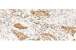Immunohistochemistry of paraffin-embedded Human esophagus cancer tissue using TEAD3 Polyclonal Antibody at dilution of 1:50(x200) (TEAD3 antibody)