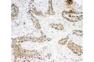 Anti-Caspase-3(P10),  IHC(P) IHC(P): Human Lung Cancer Tissue (Caspase 3 antibody  (C-Term))