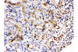 Nestin was detected in paraffin-embedded sections of human melanoma tissues using rabbit anti- Nestin Antigen Affinity purified polyclonal antibody at 1 μg/mL. (Nestin antibody  (N-Term))
