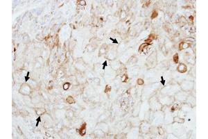 IHC-P Image Immunohistochemical analysis of paraffin-embedded SCC4 xenograft, using GIPC1, antibody at 1:100 dilution. (GIPC1 antibody  (C-Term))