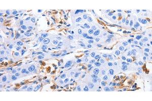 Immunohistochemistry of paraffin-embedded Human lung cancer tissue using MFN1 Polyclonal Antibody at dilution 1:60 (MFN1 antibody)
