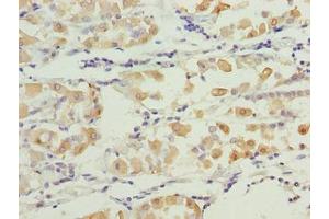 Immunohistochemistry of paraffin-embedded human gastric cancer using ABIN7171717 at dilution of 1:100 (SMG6 antibody  (AA 251-511))
