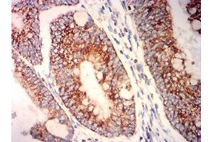 Immunohistochemical analysis of paraffin-embedded rectum cancer tissues using PLA2G7 mouse mAb with DAB staining. (PLA2G7 antibody  (AA 22-441))