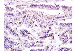 Formalin-fixed and paraffin embedded human colon carcinoma labeled with Anti-CD74/MHC II Polyclonal Antibody, Unconjugated (ABIN741435) at 1:200 followed by conjugation to the secondary antibody and DAB staining. (CD74 antibody  (AA 151-250))