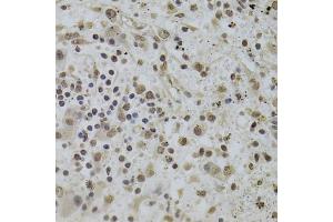 Immunohistochemistry of paraffin-embedded human liver cancer using INTS6 Antibody. (INTS6 antibody)