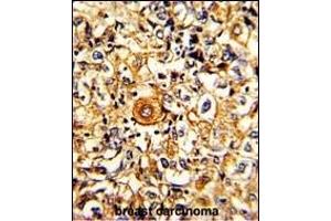 Formalin-fixed and paraffin-embedded human breast carcinoma with PTAR1 Antibody (Center), which was peroxidase-conjugated to the secondary antibody, followed by DAB staining. (PTAR1 antibody  (AA 60-89))