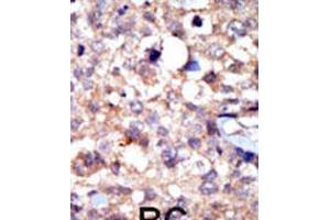 Formalin-fixed and paraffin-embedded human cancer tissue reacted with the primary antibody, which was peroxidase-conjugated to the secondary antibody, followed by AEC staining. (ABL1 antibody  (C-Term))