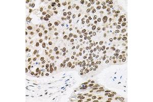 Immunohistochemistry of paraffin-embedded human lung cancer using BAF60a antibody. (SMARCD1 antibody)
