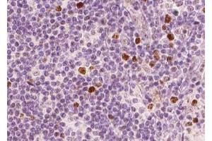ABIN6267598 at 1/100 staining human Lymphoma tissue sections by IHC-P. (NF-kB p65 antibody  (pSer311))
