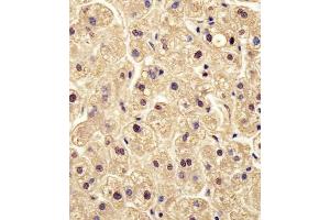 (ABIN6242566 and ABIN6578504) staining PGM1 in human liver tissue sections by Immunohistochemistry (IHC-P - paraformaldehyde-fixed, paraffin-embedded sections). (Phosphoglucomutase 1 antibody  (AA 251-282))