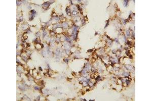 IHC-P: N-Cadherin antibody testing of human ovary cancer tissue