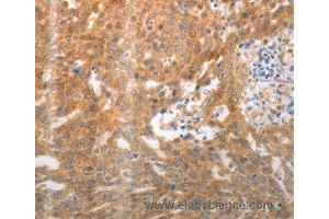 Immunohistochemistry of Human ovarian cancer using NQO1 Polyclonal Antibody at dilution of 1:25 (NQO1 antibody)