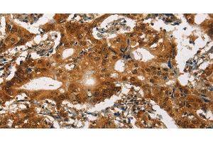 Immunohistochemistry of paraffin-embedded Human gasrtic cancer tissue using Cav1. (CACNA1C antibody)