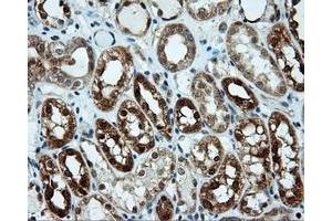 Immunohistochemical staining of paraffin-embedded Carcinoma of liver tissue using anti-LIPG mouse monoclonal antibody. (LIPG antibody)