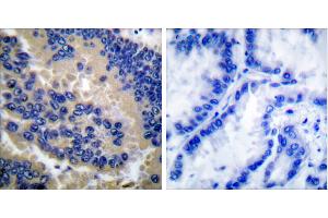 Cl-peptide - +Immunohistochemical analysis of paraffin-embedded human lung carcinoma tissue using Caspase 3 (cleaved-Asp175) antibody. (Caspase 3 antibody  (Cleaved-Asp175))