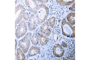 Immunohistochemical analysis of Calreticulin staining in human colon cancer formalin fixed paraffin embedded tissue section. (Calreticulin antibody  (N-Term))
