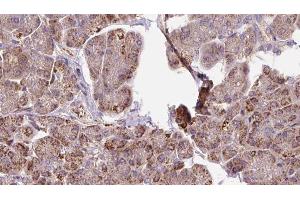 ABIN6273291 at 1/100 staining Human pancreas cancer tissue by IHC-P. (PDHB antibody  (N-Term))