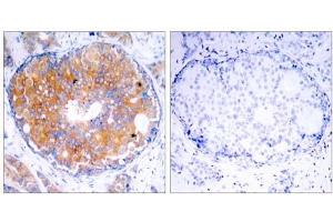 Immunohistochemical analysis of paraffin-embedded human breast carcinoma tissue using MEK2 (Ab-394) antibody (E021008). (MEK2 antibody)